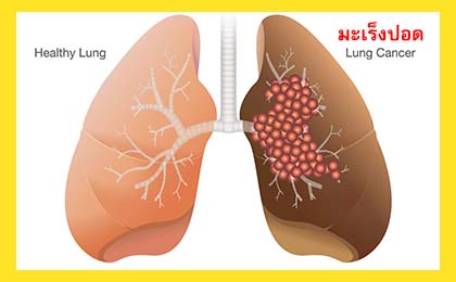 lung cancer