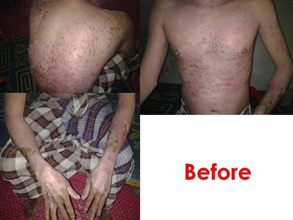 Case review Psoriasis 1_betaglucan-maho