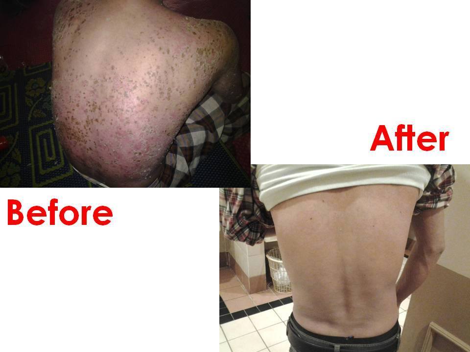 Case review Psoriasis 2_betaglucan-maho