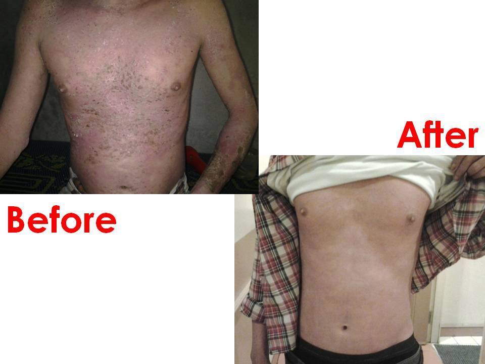 Case review Psoriasis 3_betaglucan-maho