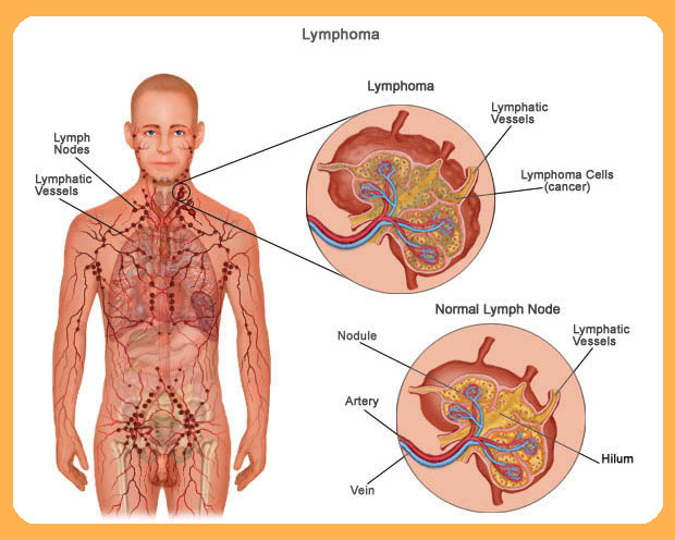 Lymphoma_betaglucan-maho