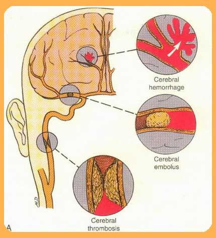 Stroke maho betaglucan