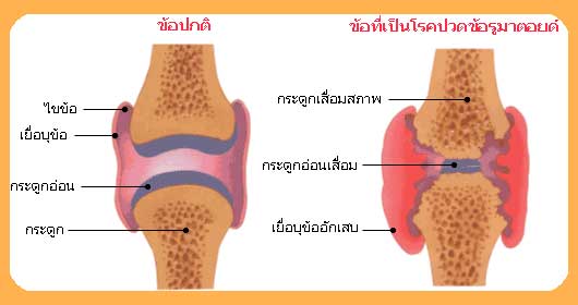 Rheumatoid Arthritis_maho betaglucan